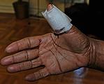 Yvonne Braswell's injured hand