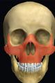 Le Fort III facial fracture