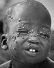 starving african child with flies on face